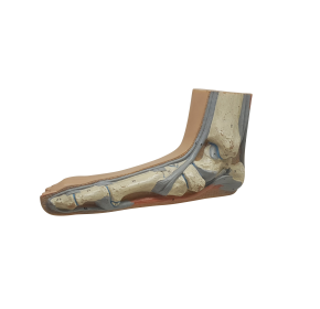 평발, Flat Foot