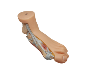 무지외반, Hallux_Valgus Foot