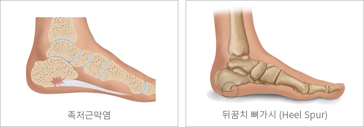 발뒤꿈치 통증