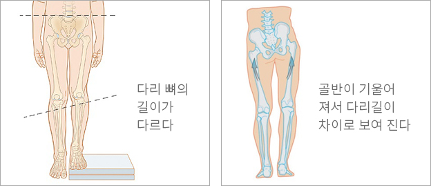다리길이차이