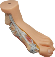 무지외반, Hallux_Valgus Foot